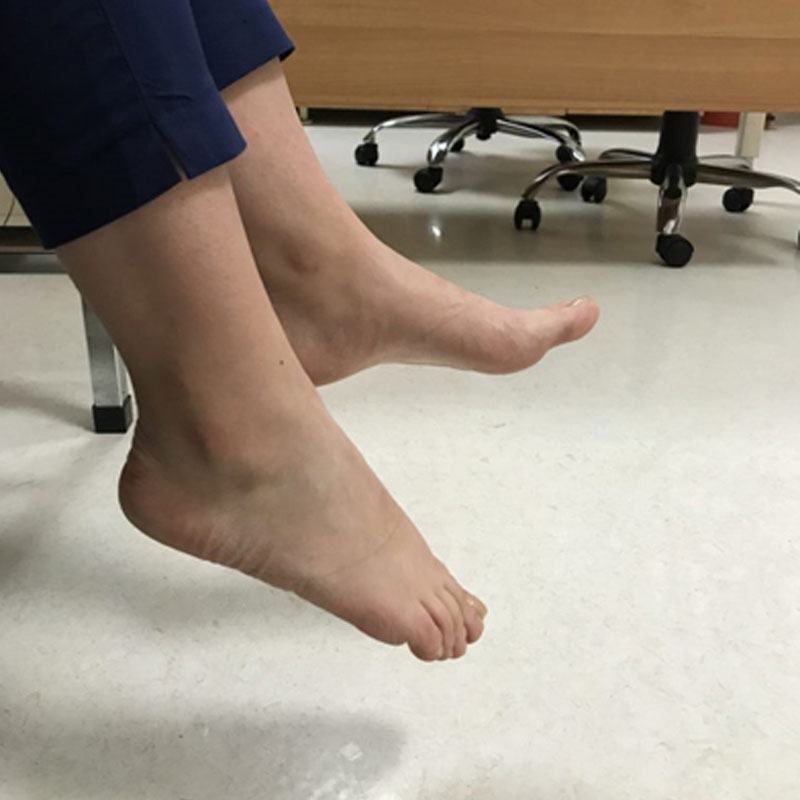 Düşük Ayak Sendromu